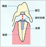 アタッチメントデンチャー